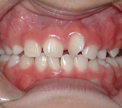 My child has crooked teeth, will he or she need braces?