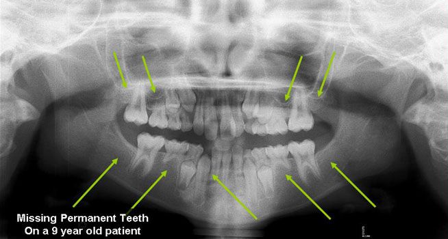 Missing Permanent Teeth