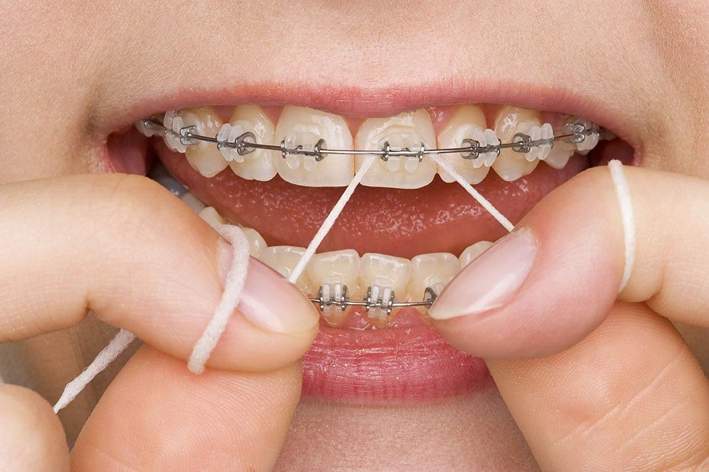 Flossing with Orthodontics