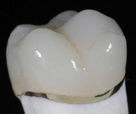 Porcelain Fused To Metal Crown (PFM)