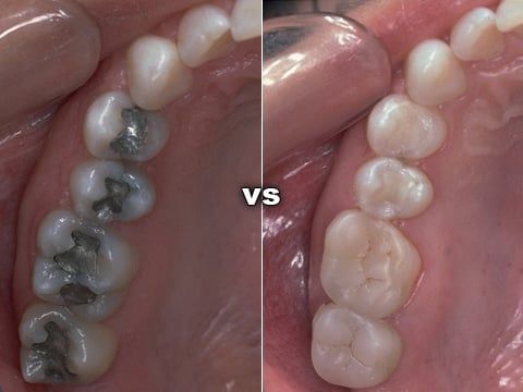 Tooth Colored Fillings