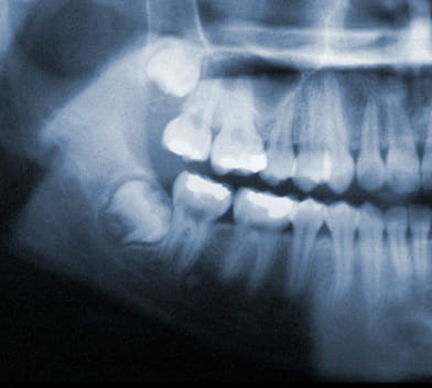 Wisdom Tooth Development