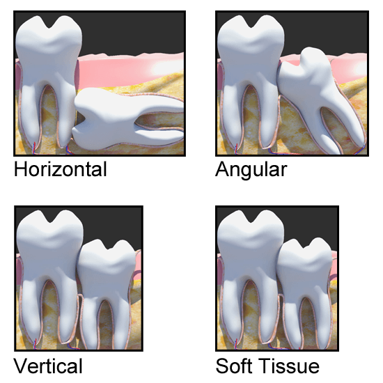 Wisdom Tooth Positions